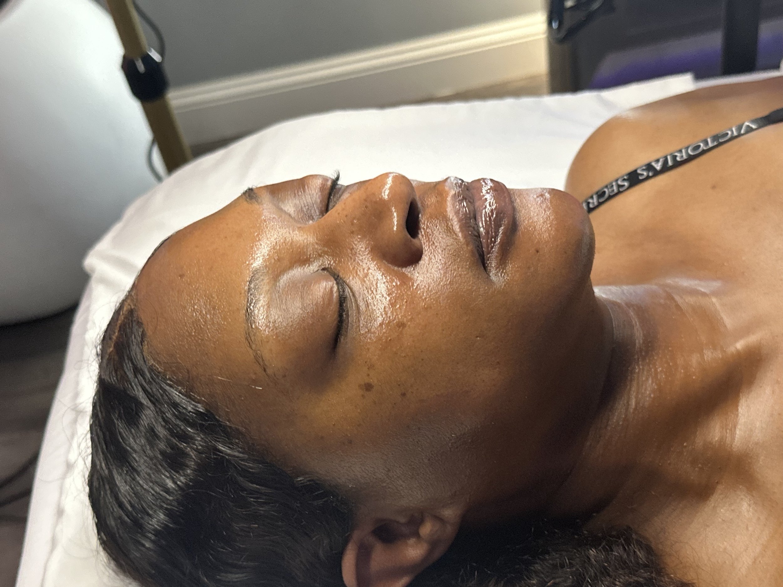 A client who received Glass Skin from a hydrafacial and dermaplane facial at Glow Setters Skin Studio.