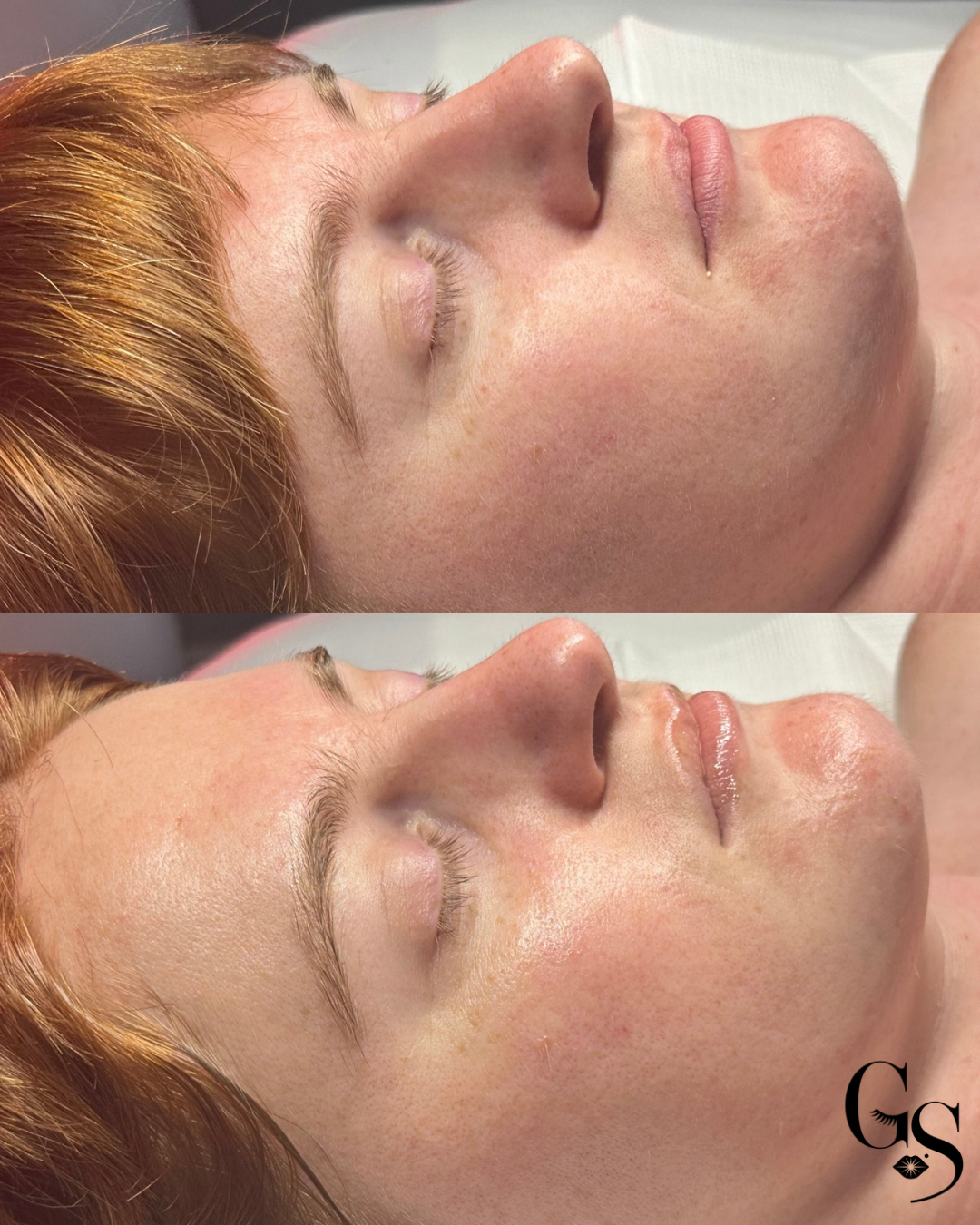 Close-up of a woman's face before and after a skincare treatment, showing improved skin texture and glow from facial at Glow Setters Skin Studio.