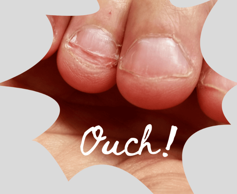 painful short nails