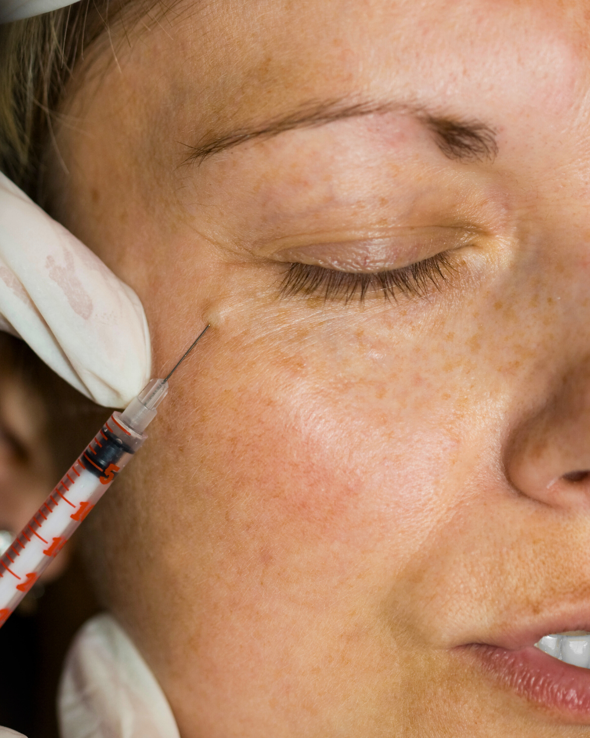 A person receiving a cosmetic injection or treatment near the cheek under the eye, with a healthcare professional using gloves and a syringe.
