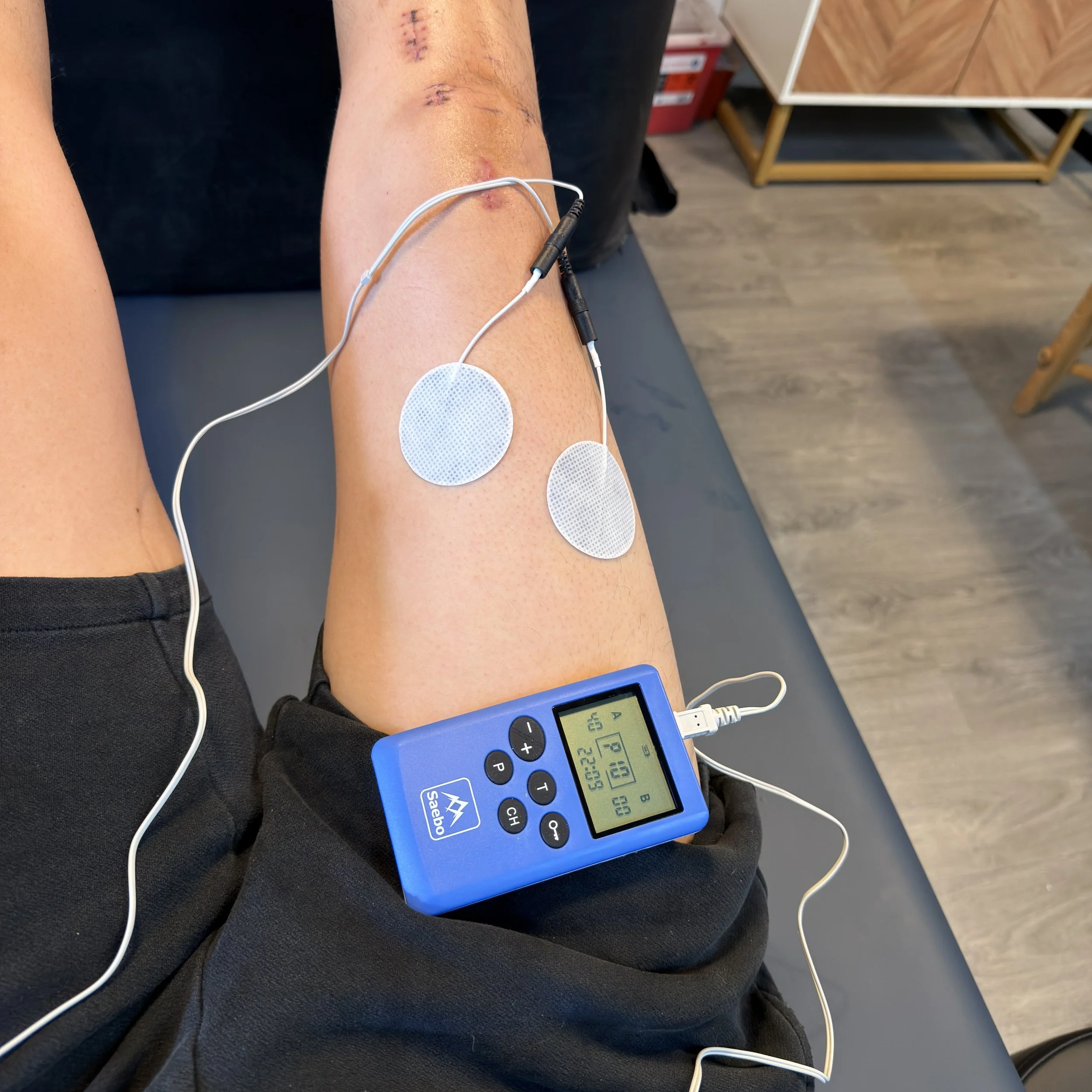 A person's forearm shows surgical scars and healing wounds. Electrodes are attached to the arm, connected to a blue digital device displaying readings. The setting appears to be a medical or clinical environment.