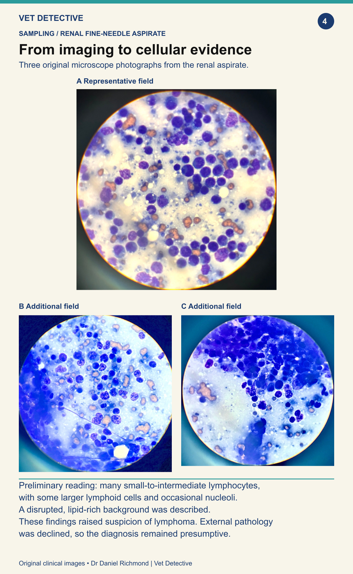 Three microscope fields from a feline renal fine-needle aspirate showing a mixed lymphoid population; lymphoma was suspected but remained unconfirmed because external pathology was declined.