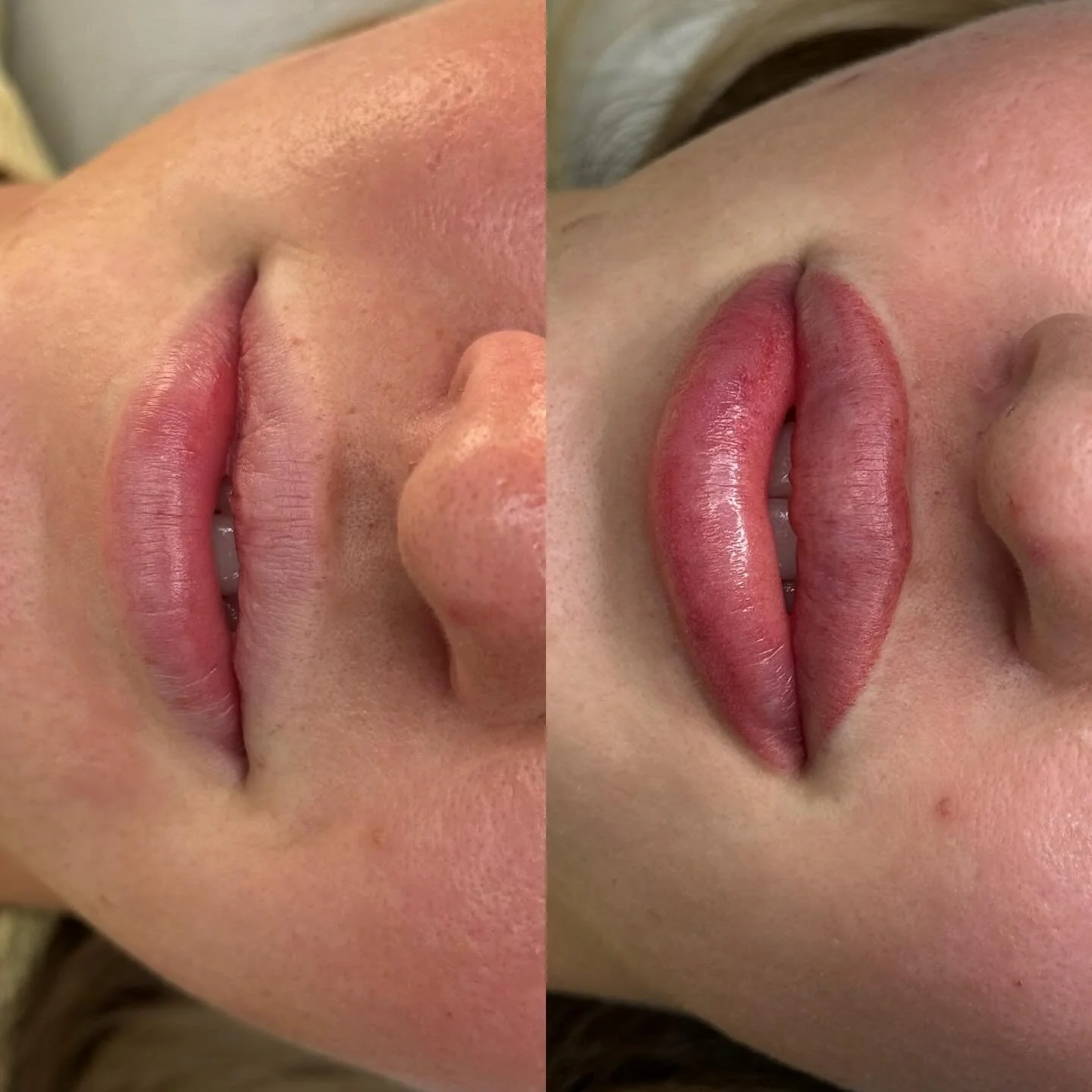 Soft, natural lip blush transformation ✨

This client wanted to enhance her natural lip colour while keeping everything soft and subtle. The result is a more even tone, gentle definition and a fresh, healthy blush to the lips.

Swelling straight afte