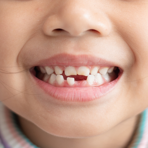 Close-up of a child's smile showing missing teeth.