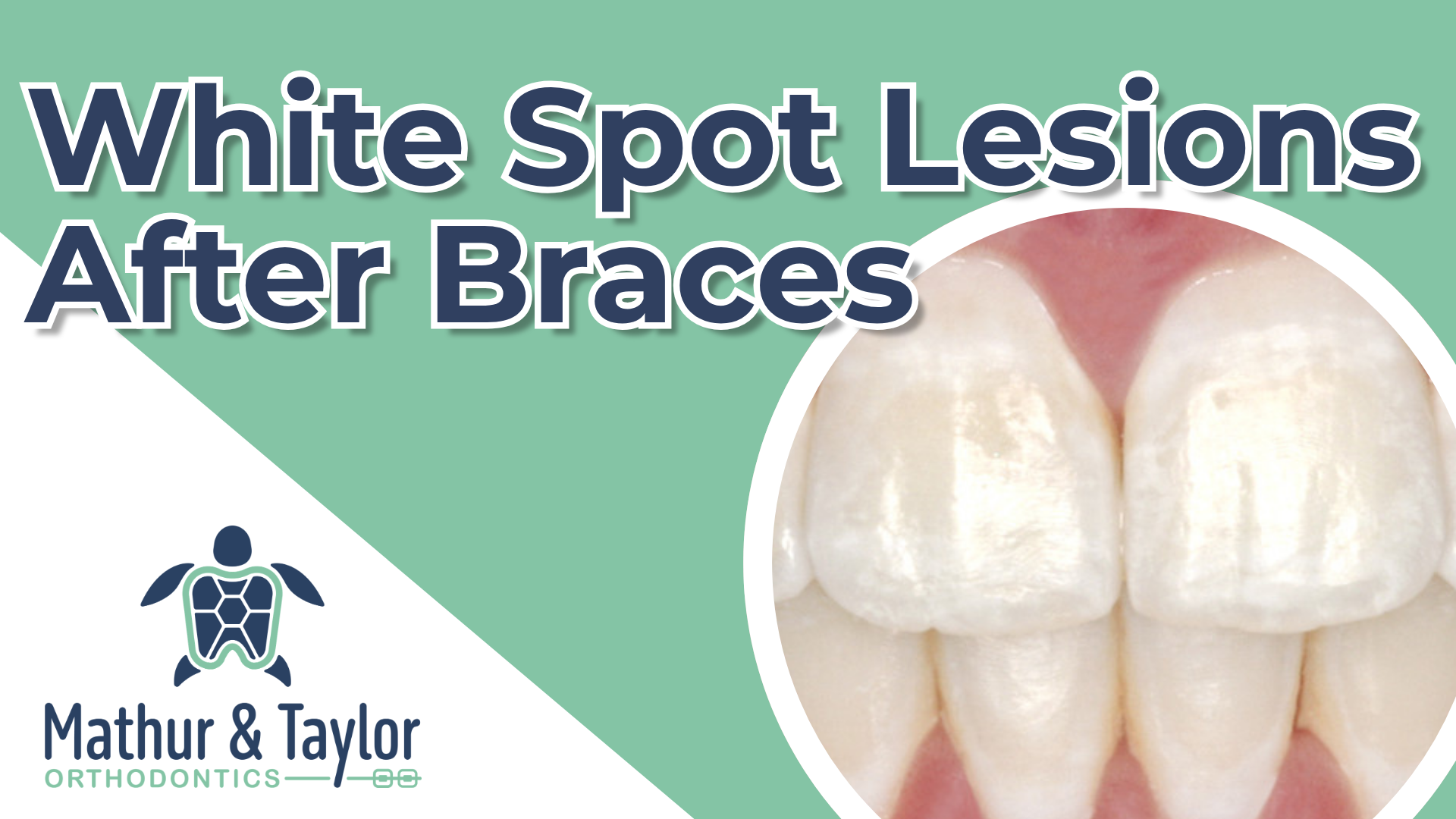 White Lesions on Your Teeth After Braces: What to Do Next