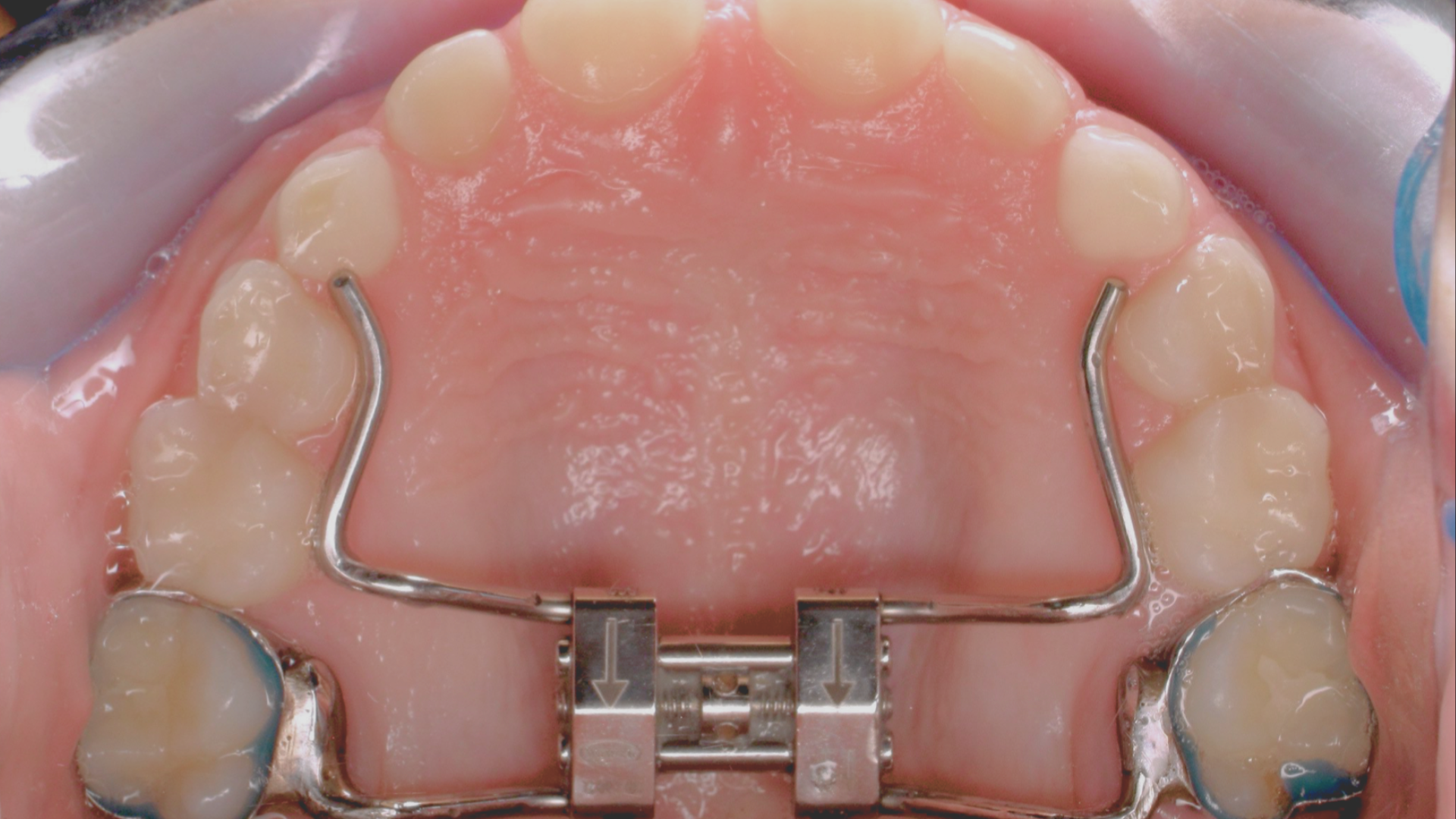A palate expander set inside the maxilla (upper jaw).