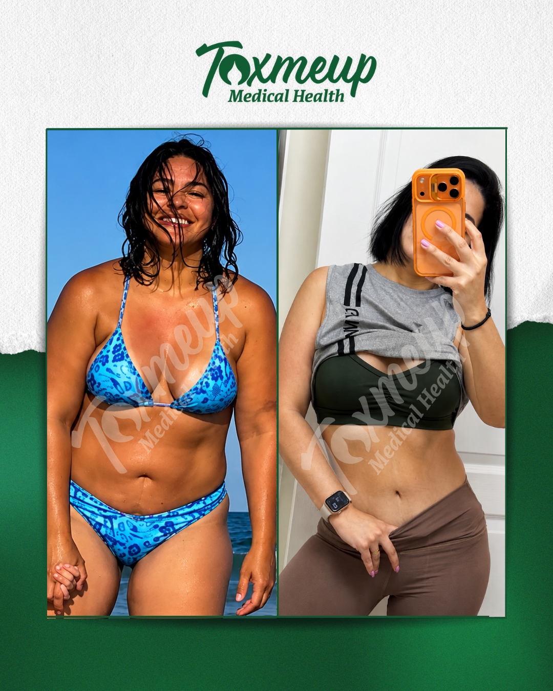 Toxmeup patient before and after result