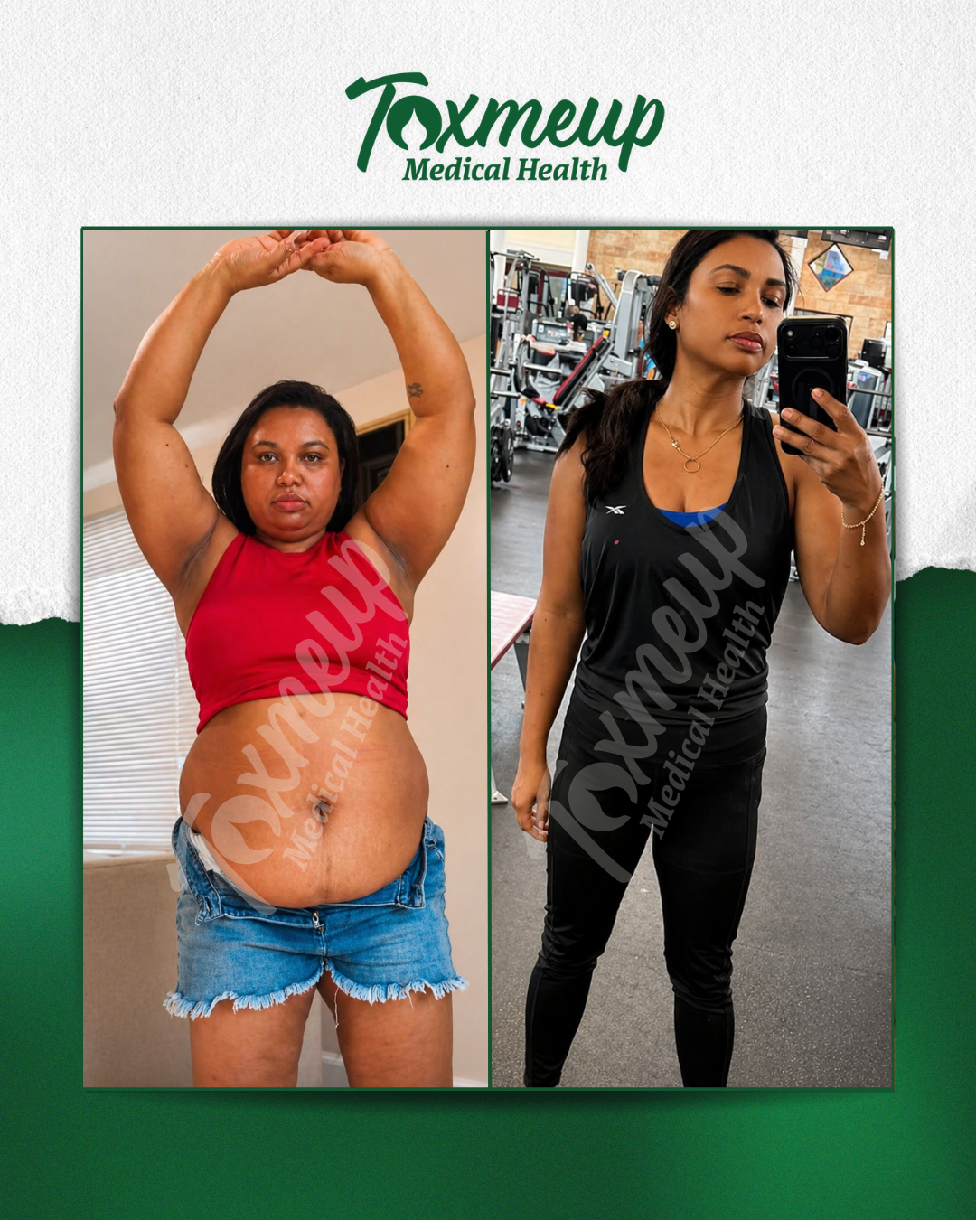 Toxmeup patient before and after result