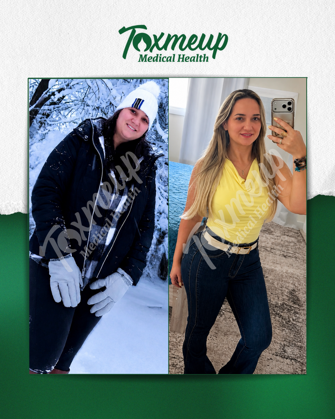 Toxmeup patient before and after result