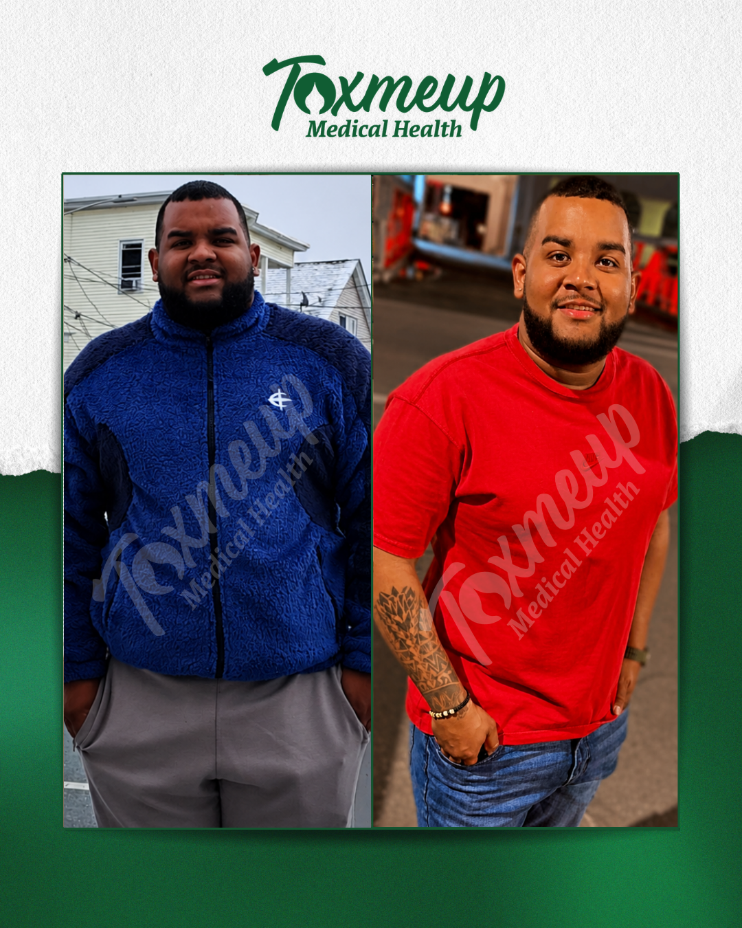 Toxmeup patient before and after result