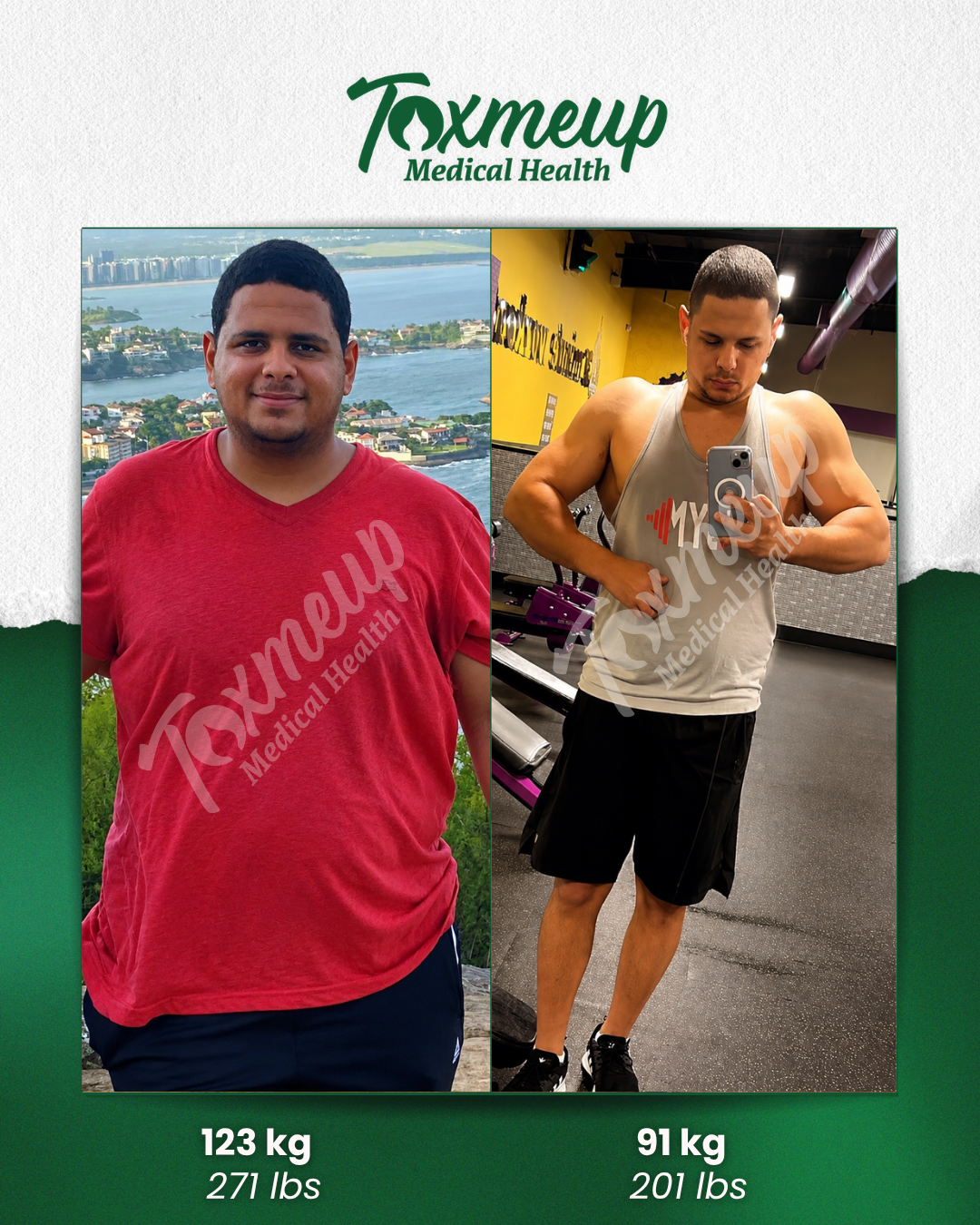 Toxmeup patient before and after result