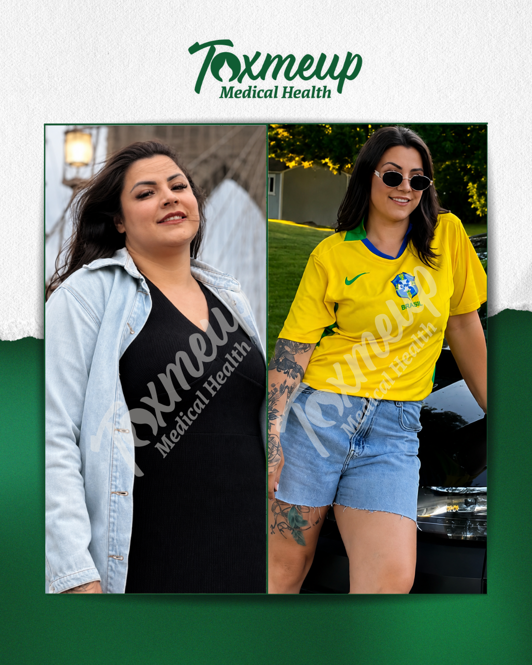 Toxmeup patient before and after result