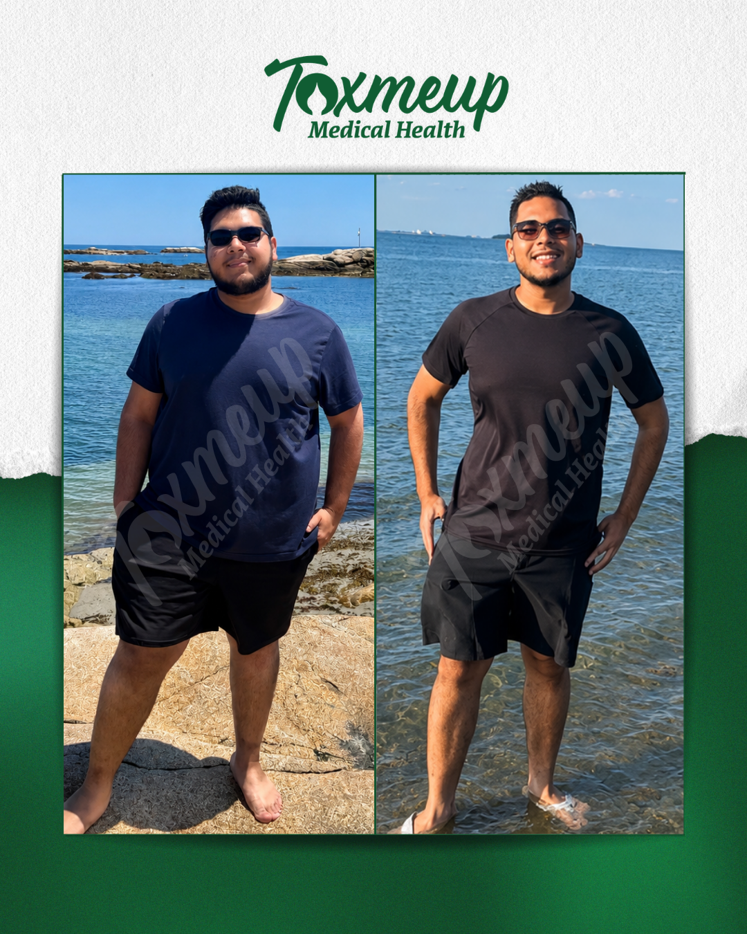 Toxmeup patient before and after result