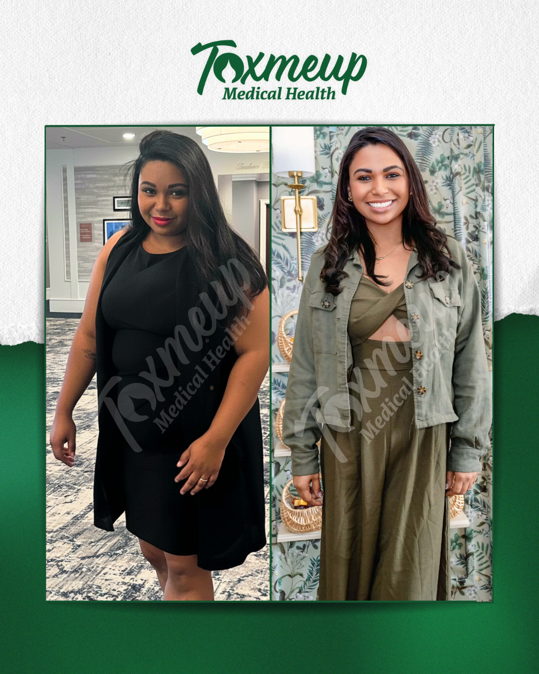 Toxmeup patient before and after result