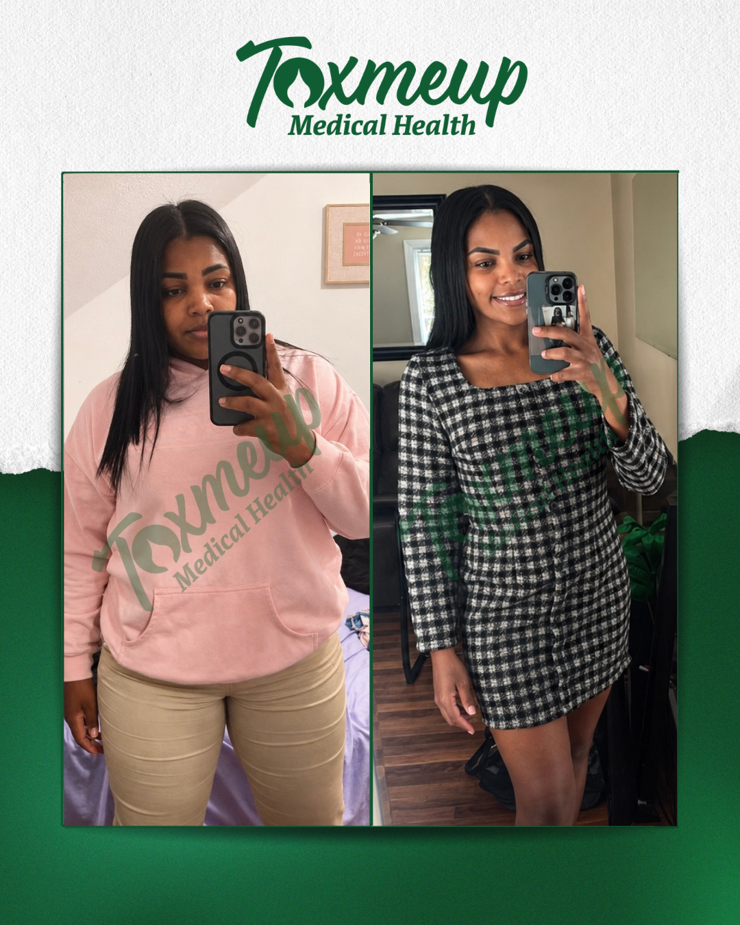 Toxmeup patient before and after result