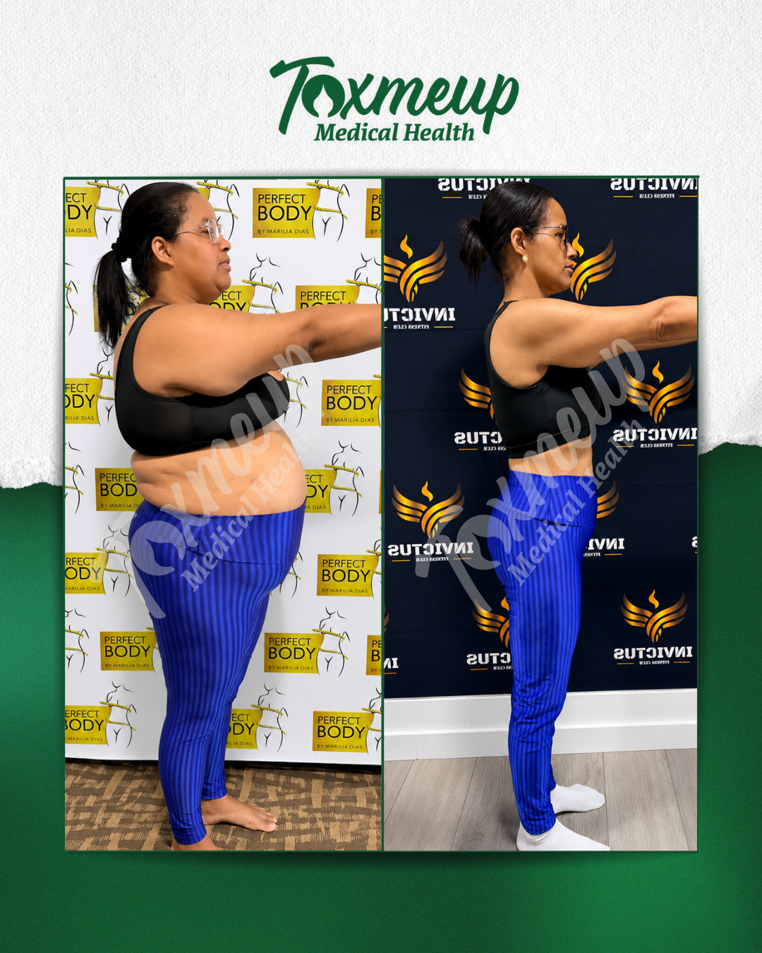Toxmeup patient before and after result