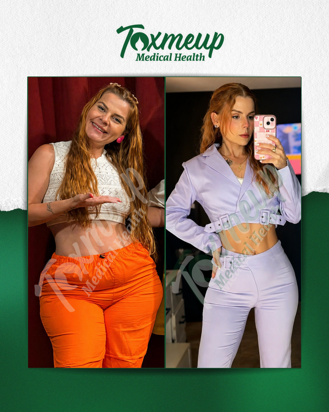 Toxmeup patient before and after result