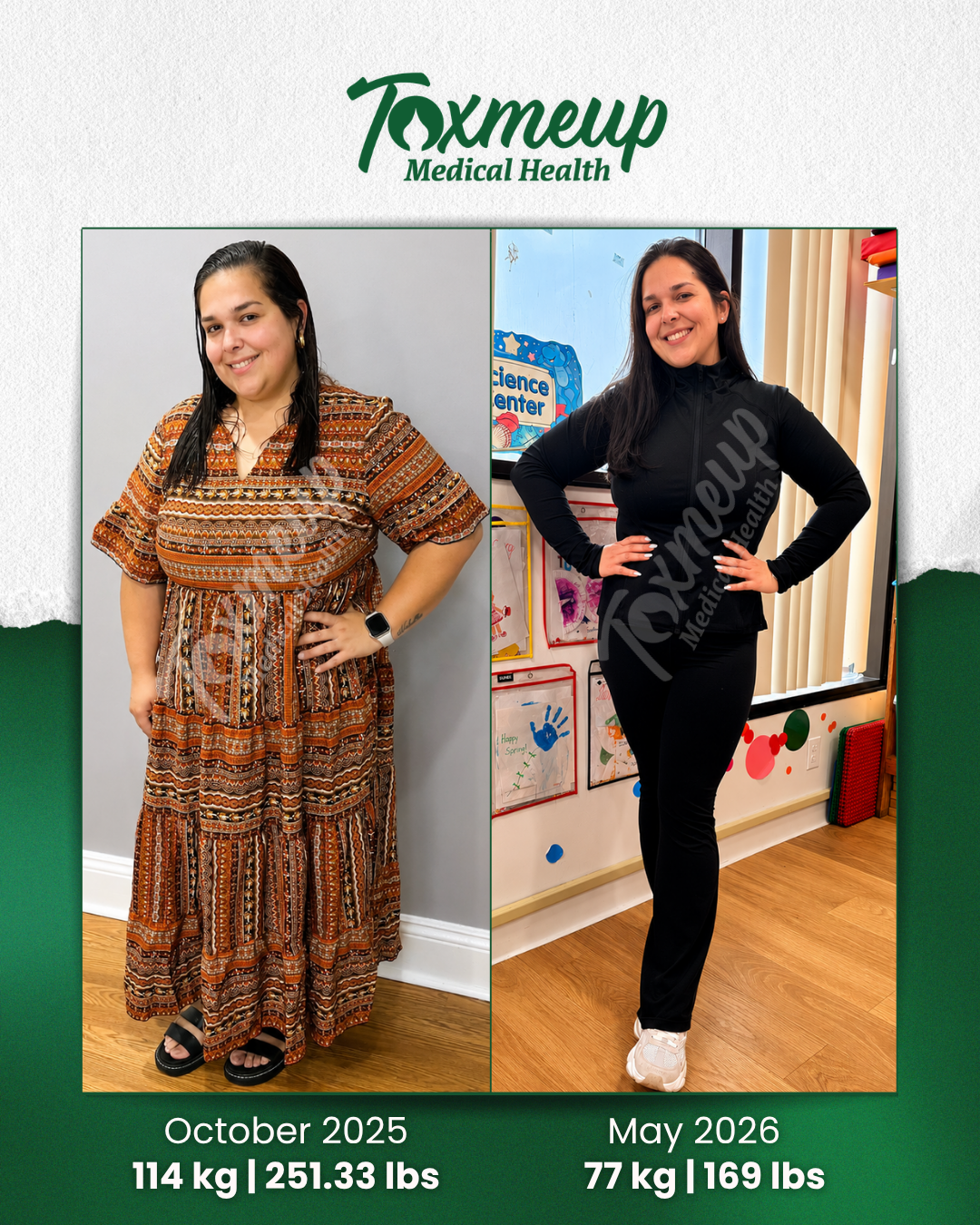 Toxmeup patient before and after result — October 2025 to May 2026