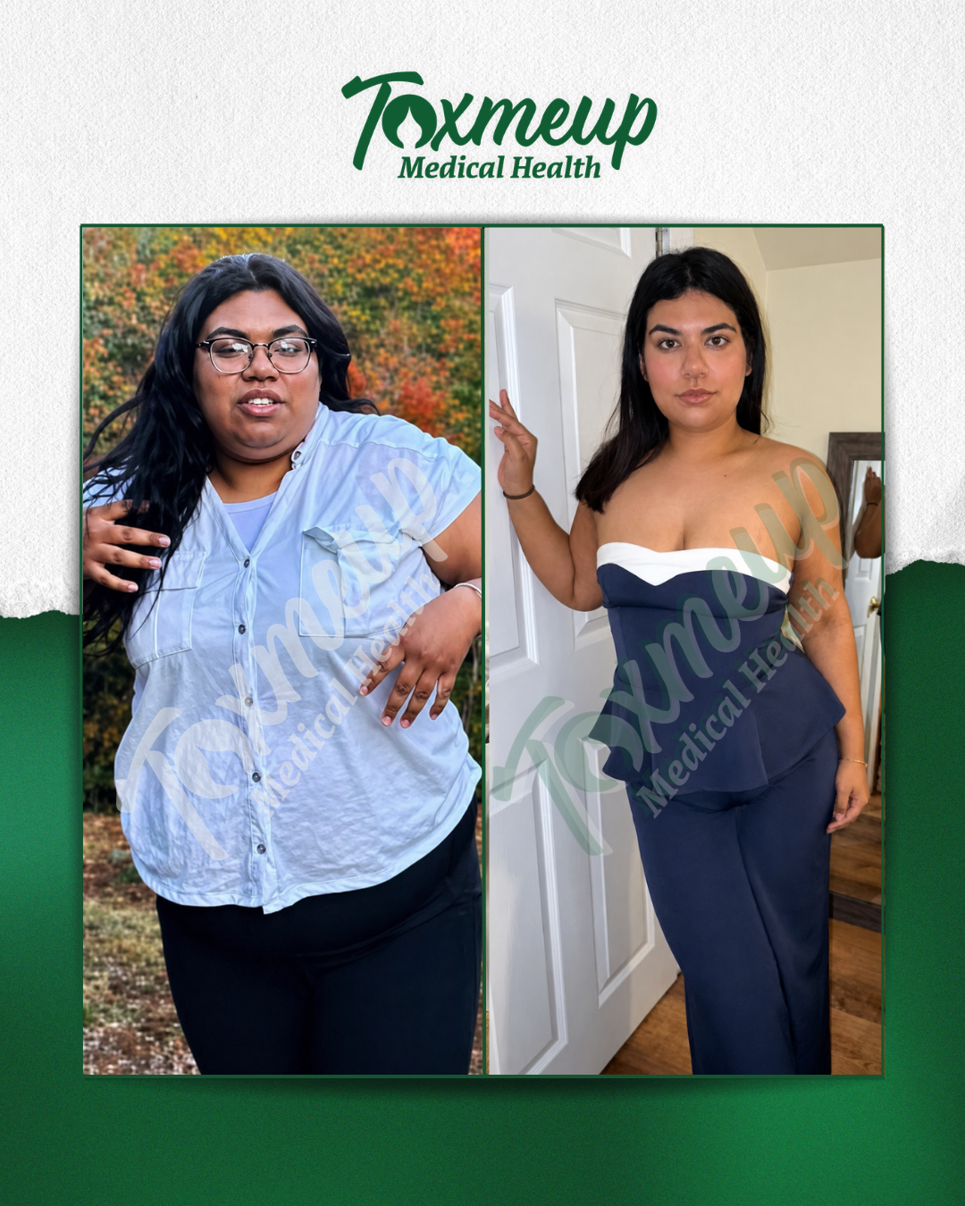 Toxmeup patient before and after result