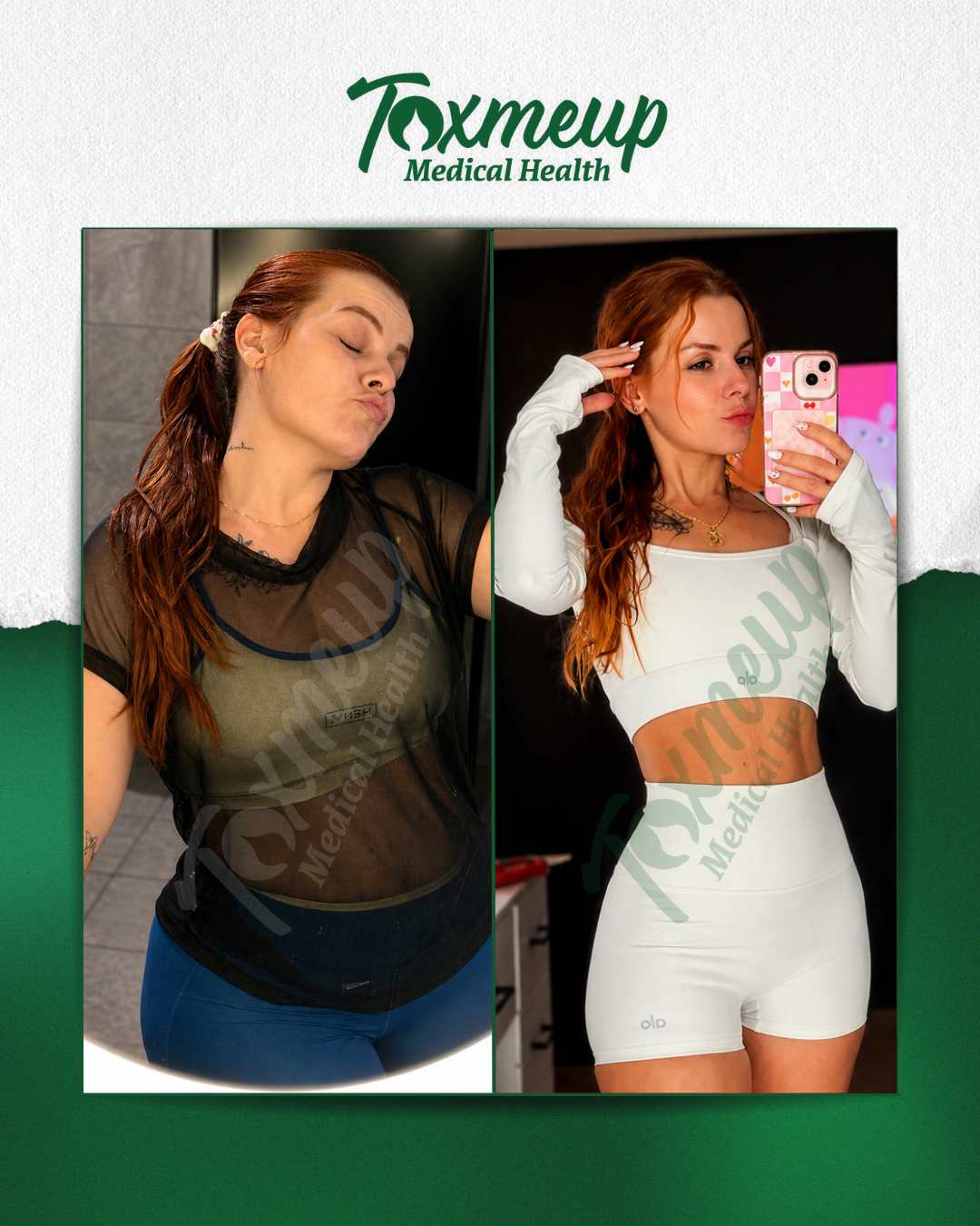 Toxmeup patient before and after result