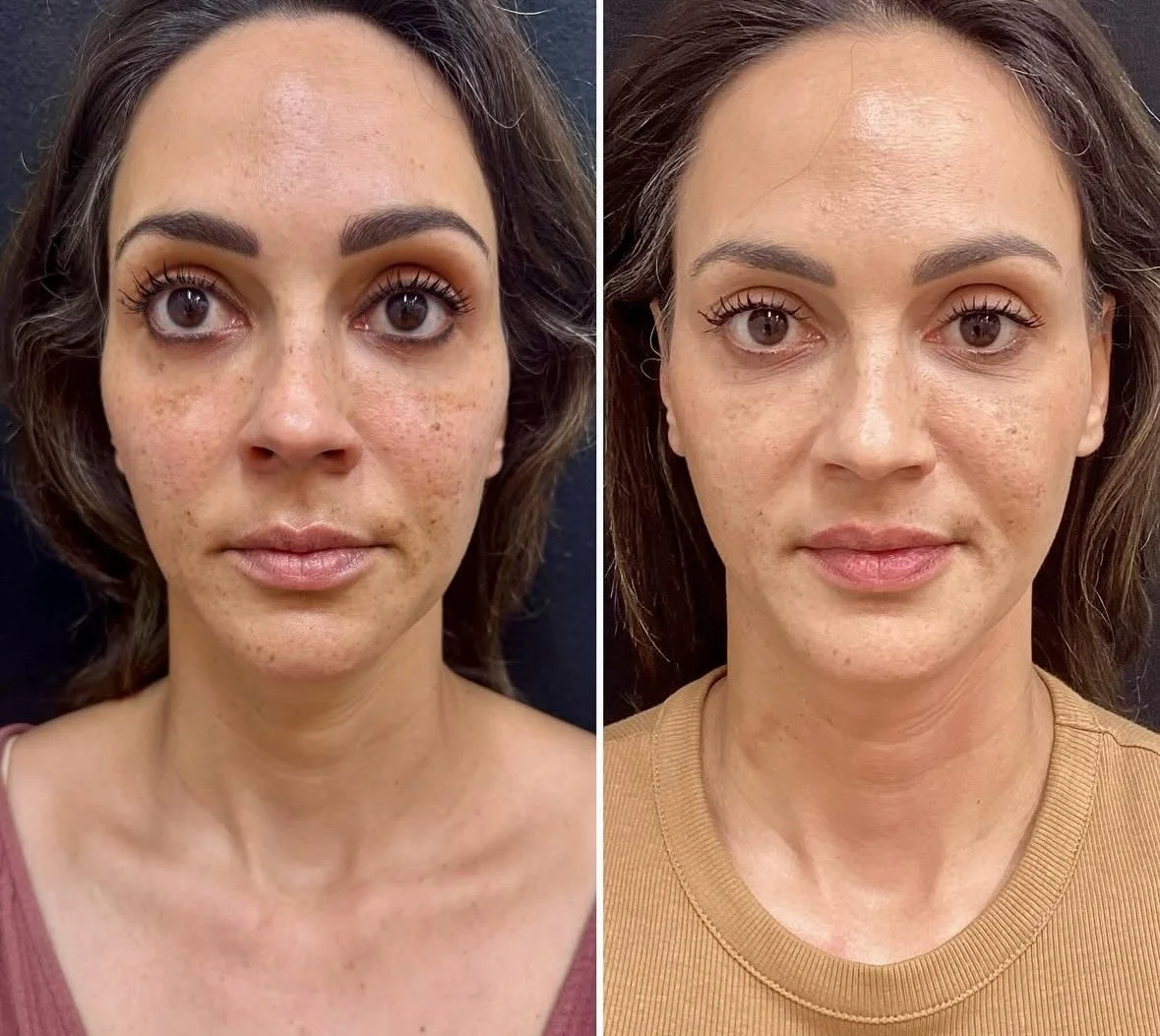 Medspa Services in Hermosa Beach, CA, 90254