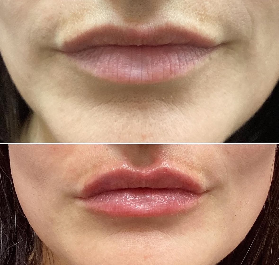 Medspa Services in Hermosa Beach, CA, 90254