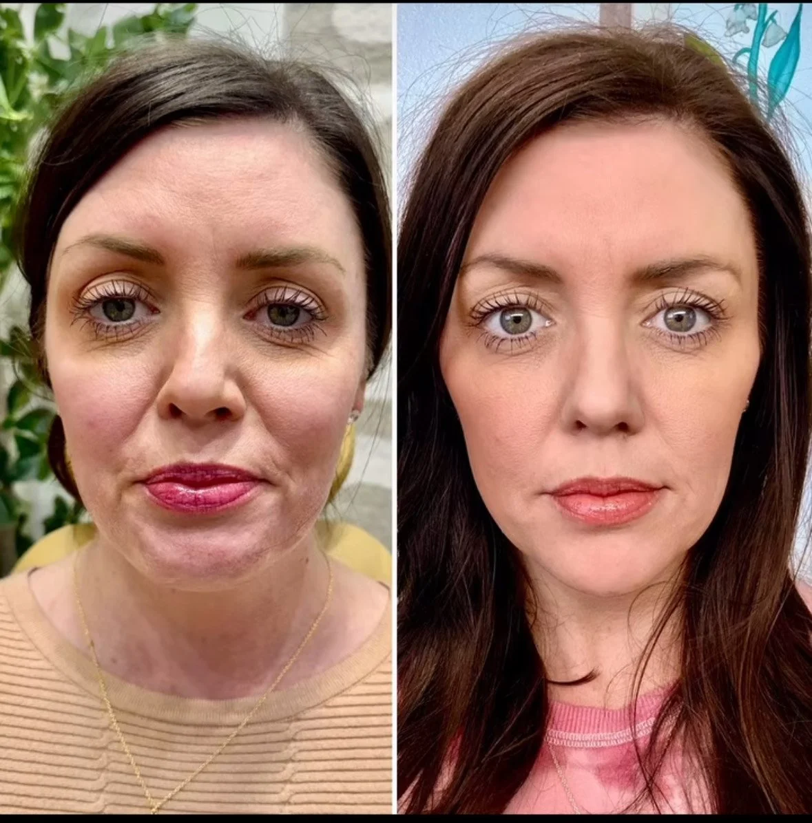 Medspa Services in Hermosa Beach, CA, 90254