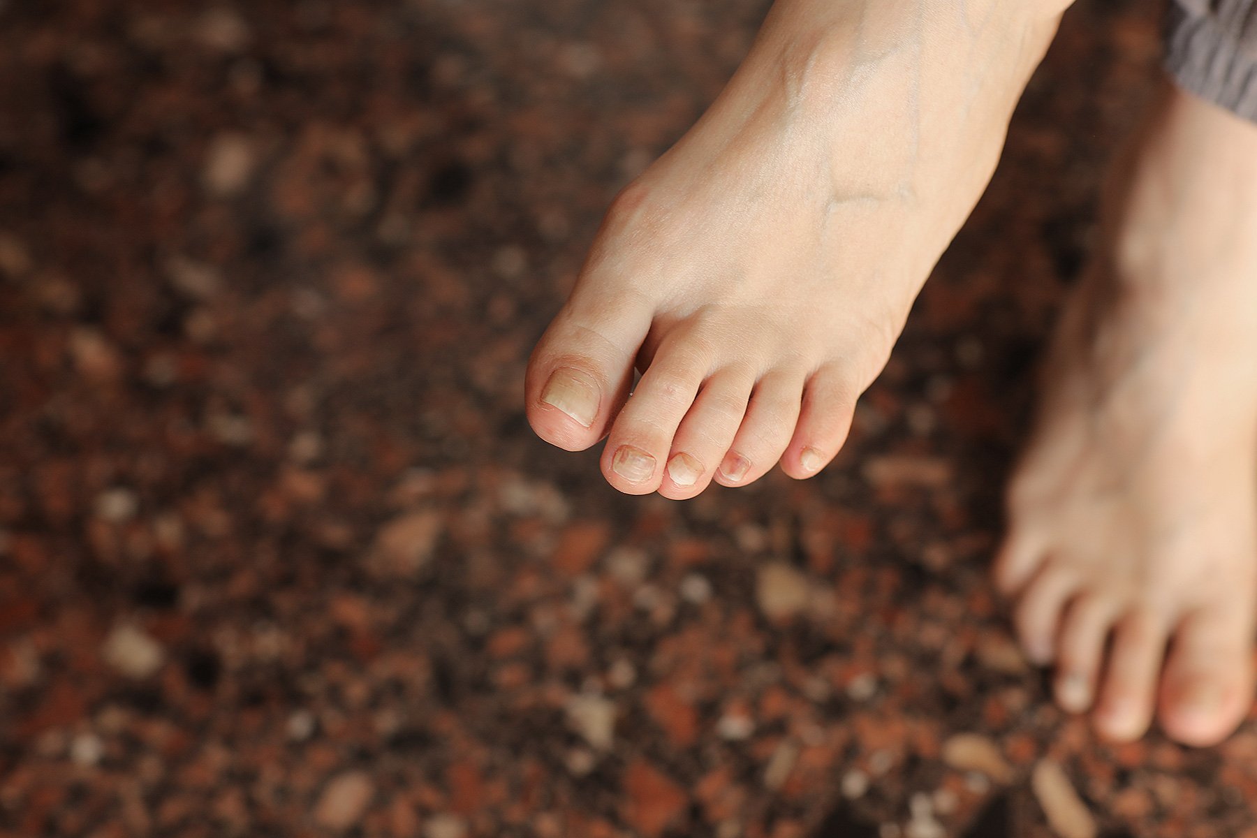 Understanding Forefoot Nerve Pain: Causes and Relief for Morton's Neuroma