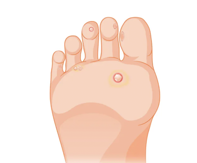 Illustration of a human hand with several skin lesions, including multiple small bumps and a larger, raised sore on the palm.
