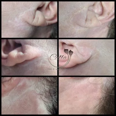 A collage of close-up images showing the before and after treatment of skin around the ear and hairline, likely illustrating skin improvements or cosmetic procedures.
