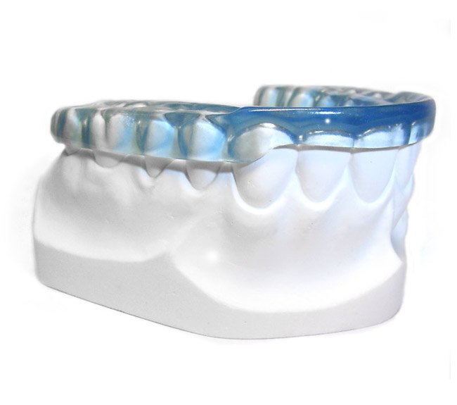 Close-up of a dental retainer on a white dental model.