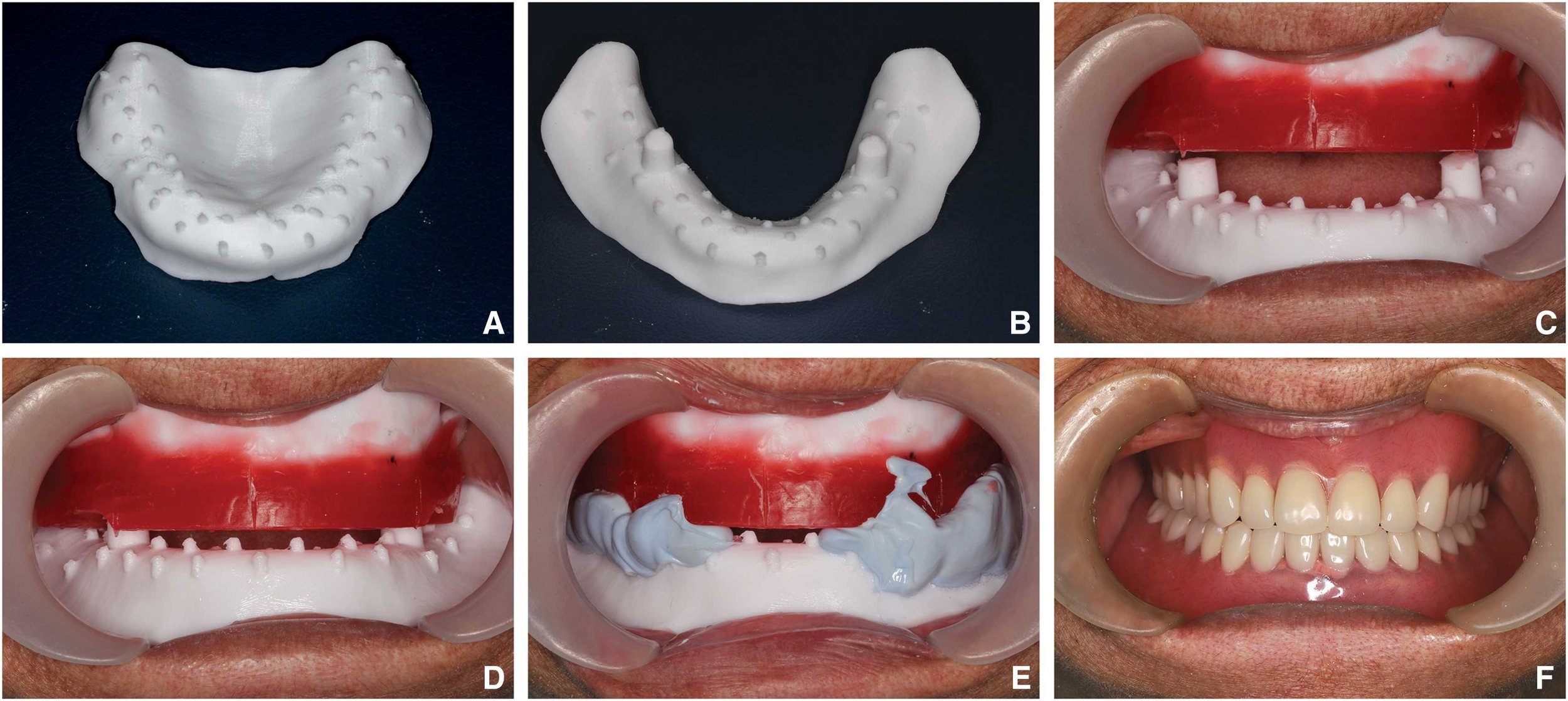 Sequence of images showing the process of making and fitting a denture. Top row: model of the upper and lower dentures. Middle row: fitting the denture in a person's mouth. Bottom row: the final look with a full set of teeth.