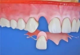 A dental model showing a missing front tooth, adjacent teeth, and a gum model with a blue background.