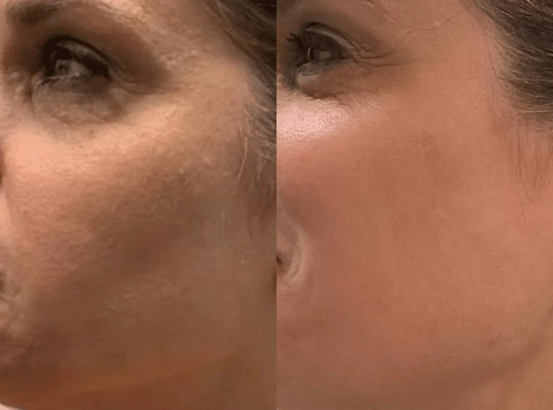 Close-up of a woman's face showing a before and after comparison of skin, highlighting improvements in skin texture and tone.