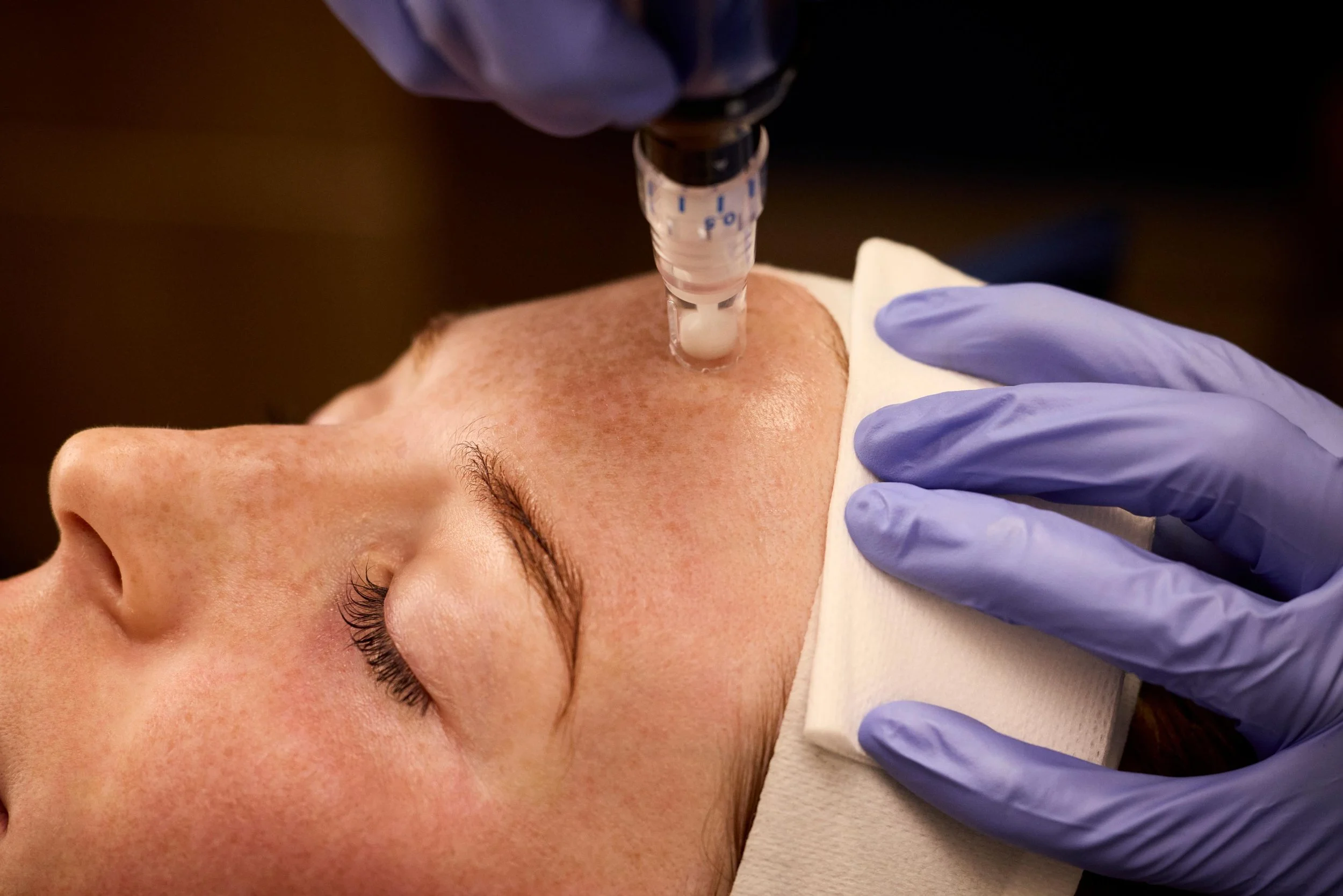 A person receiving a facial injection from a medical professional wearing blue gloves, with the person's face relaxed and eyes closed.