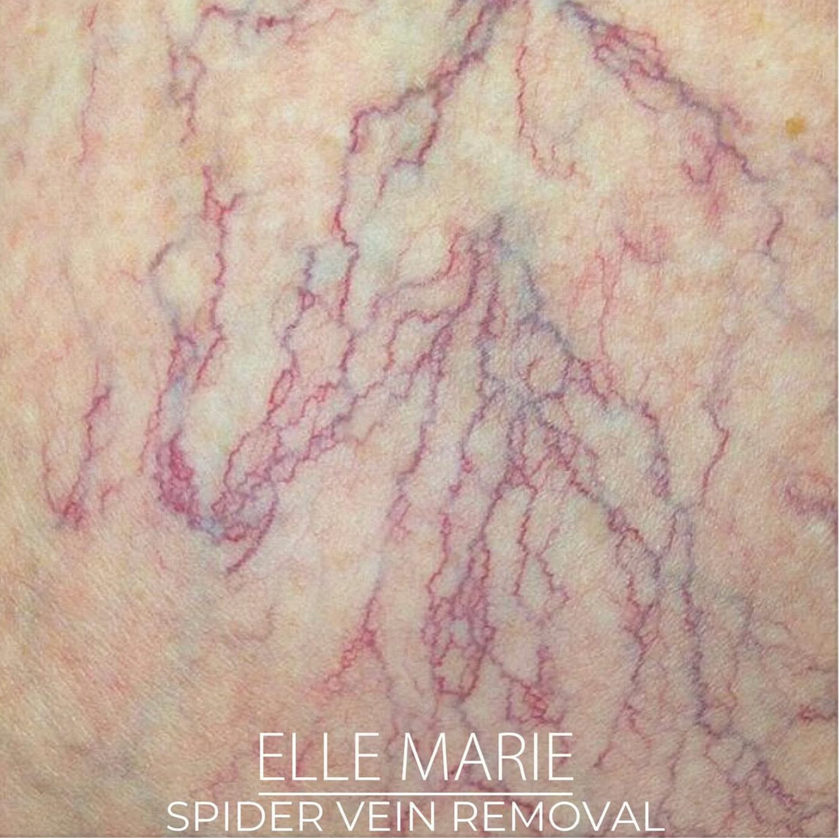 Close-up of a spider vein on skin with redness and visible broken blood vessels. Text overlay reads 'Elle Marie Spider Vein Removal'.