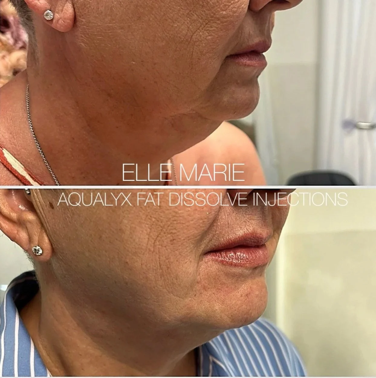 Side-by-side comparison of a woman's lower face before and after Aqualyx fat dissolving injections, showing reduced submental fat and a more contoured jawline.