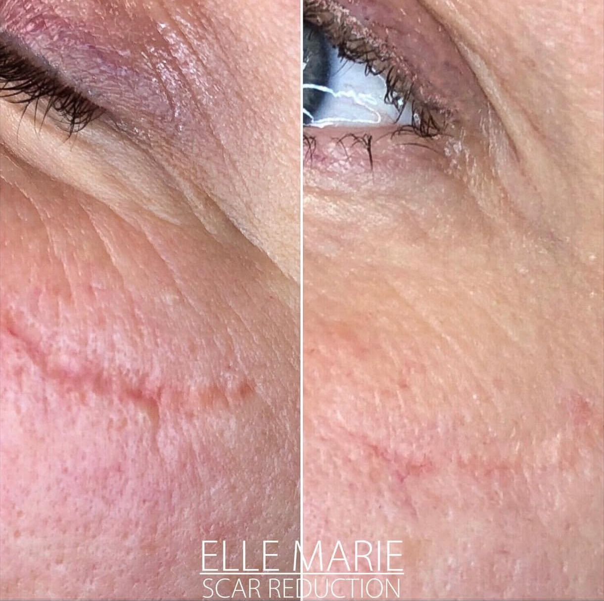 Microneedling for scars
