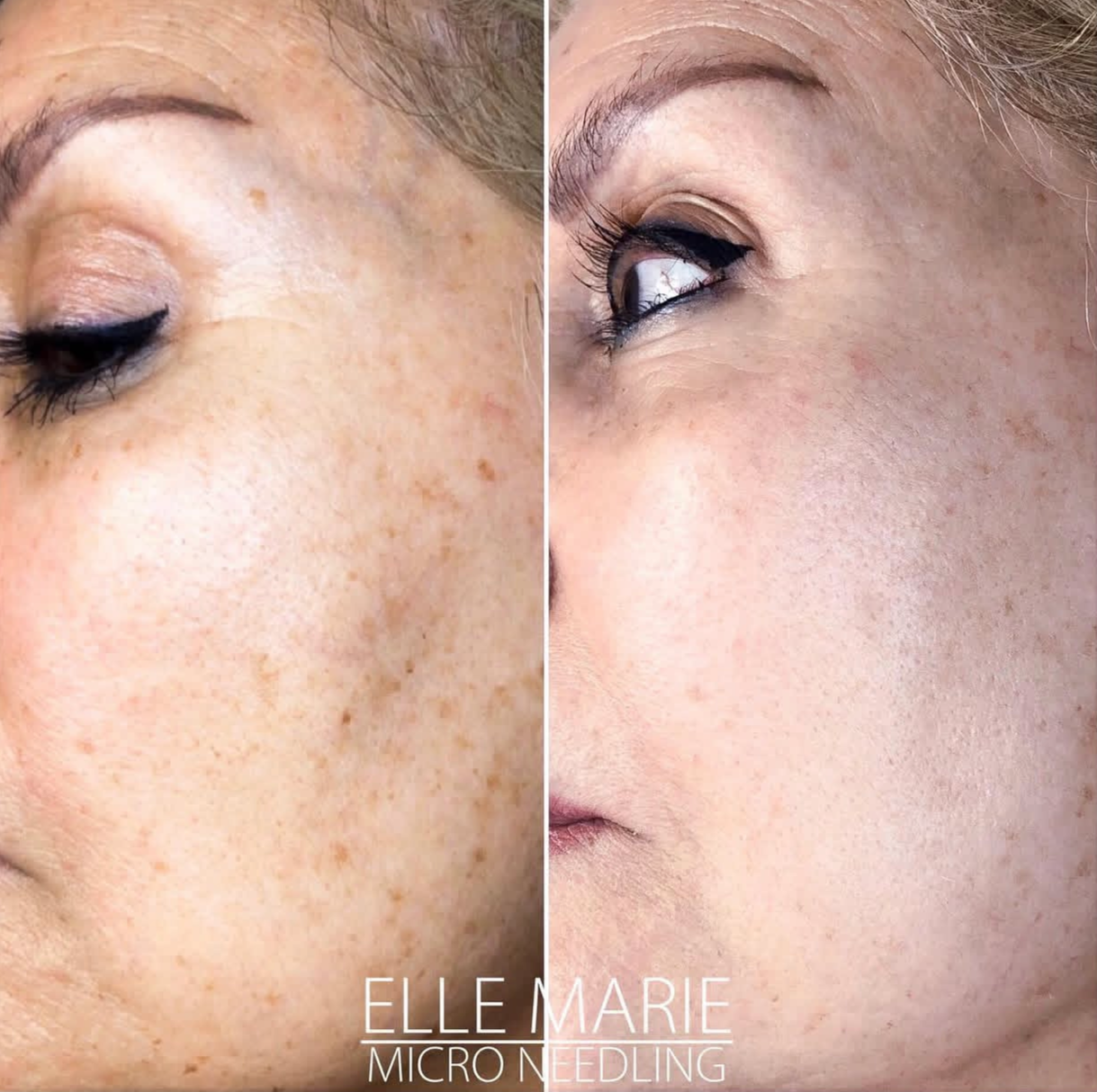 Microneedling hyperpigmentation