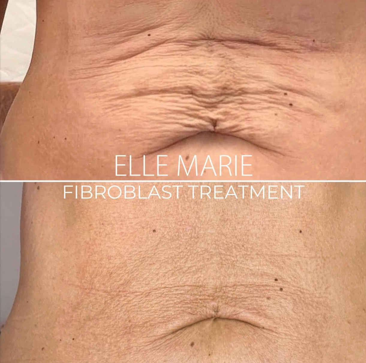 Close-up of a person's abdomen showing before and after results of fibromyalgia treatment with Elle Marie, highlighting changes in skin texture.