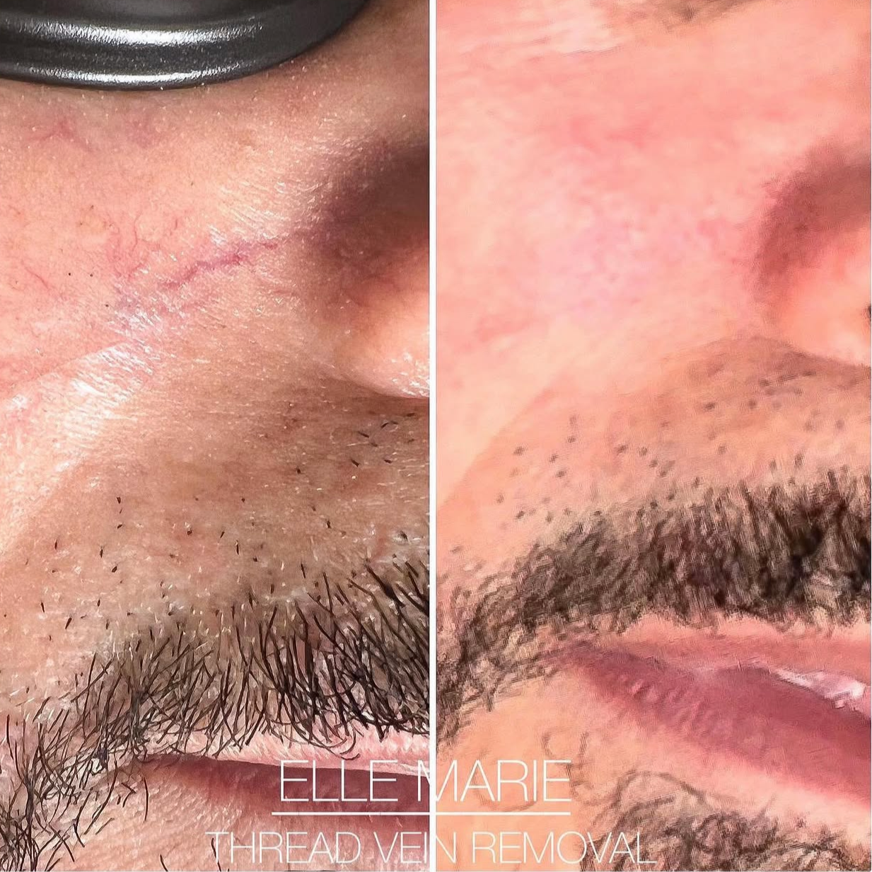 Thread vein removal face