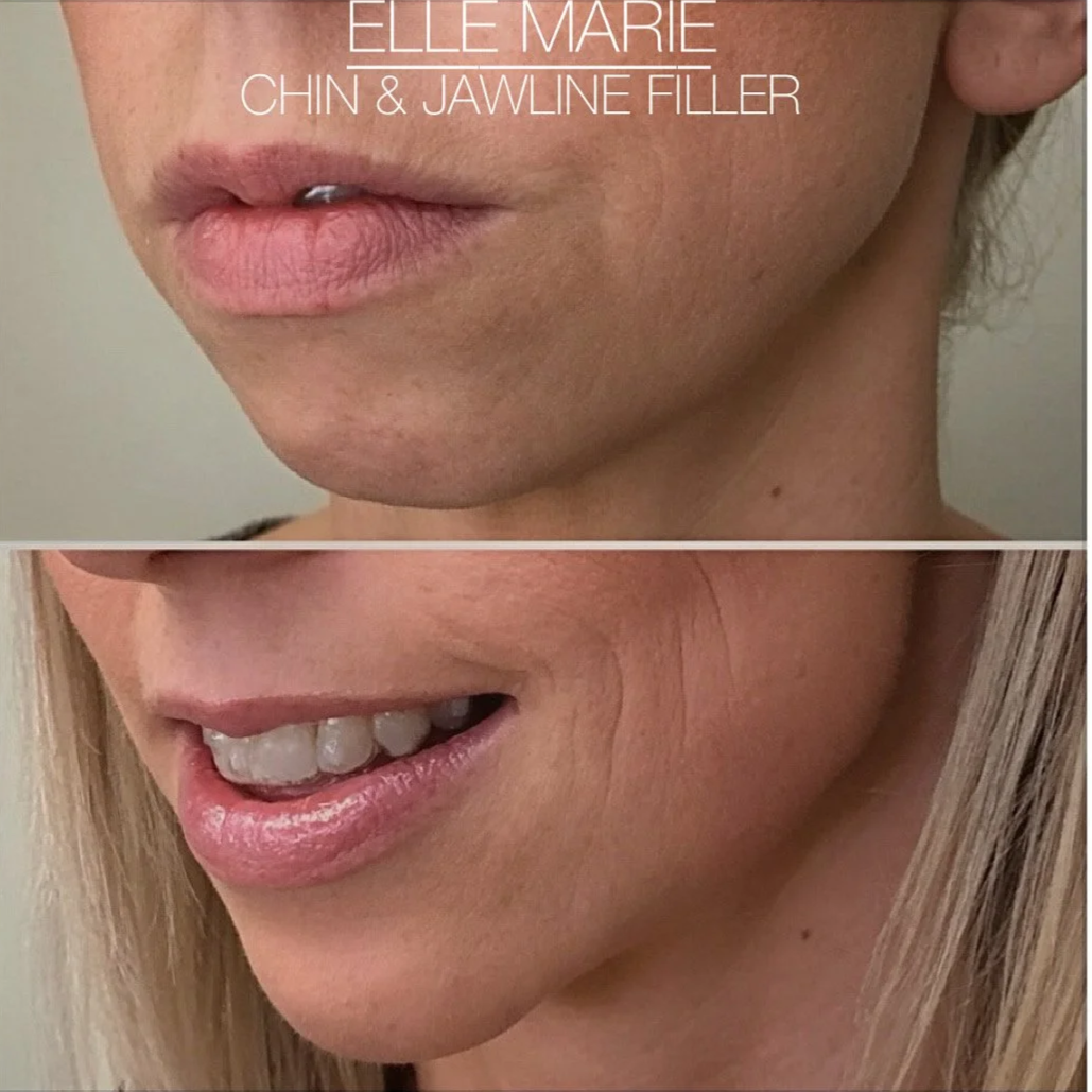 Close-up of a woman's face showing before and after images of chin and jawline filler treatment, with the woman smiling in the lower image.