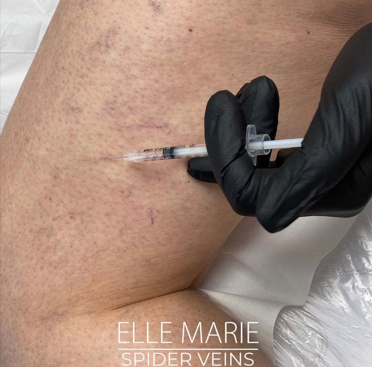 A person wearing black gloves receiving a shot or injection into their skin on their back, which has spider veins.