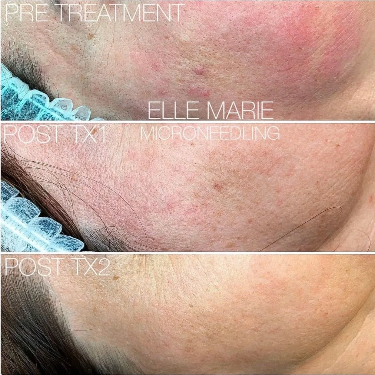 Microneedling on face