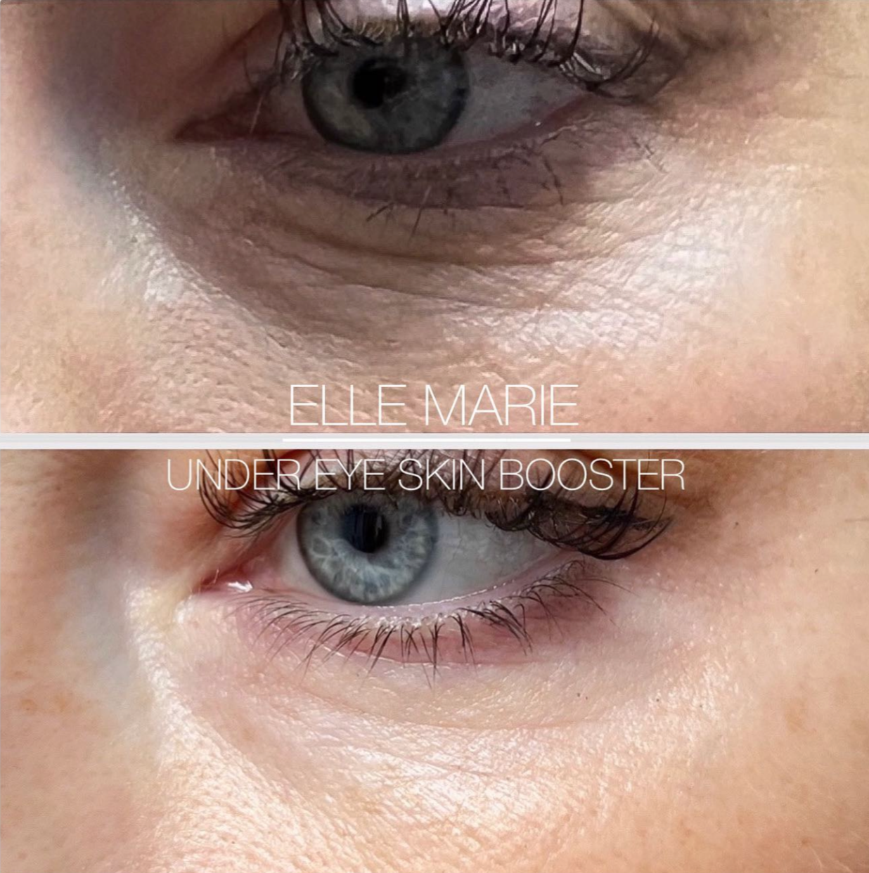 under eye skin booster profhilo