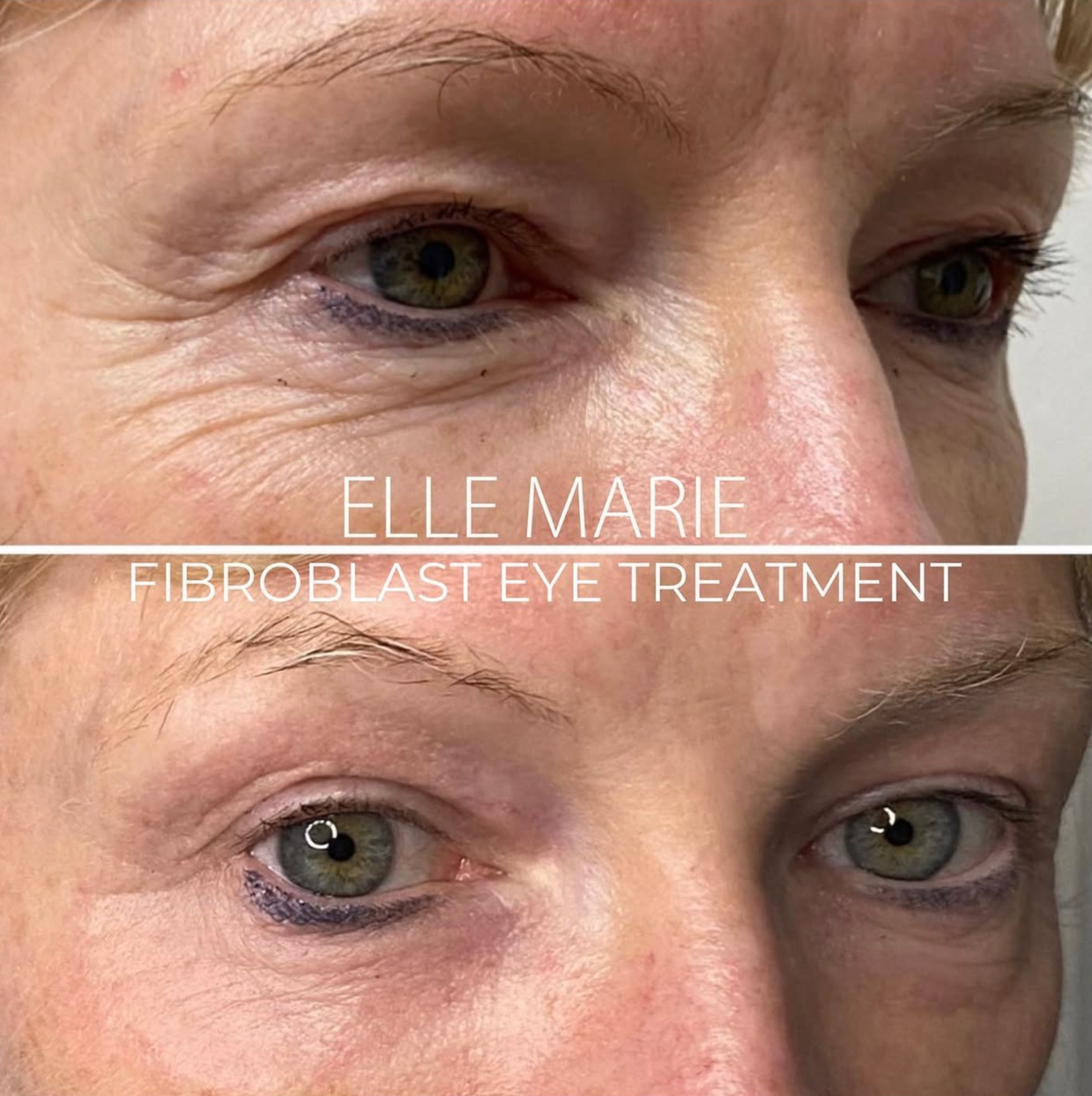 Close-up comparison of a woman's eye before and after Elle Marie Fibroblast Eye Treatment, showing reduced wrinkles and improved skin smoothness around the eye area.