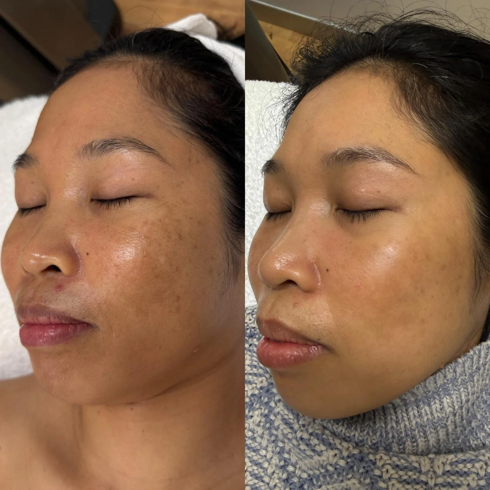 Pico Toning 2 - Chloe Regan Cosmetic Clinic.jpeg