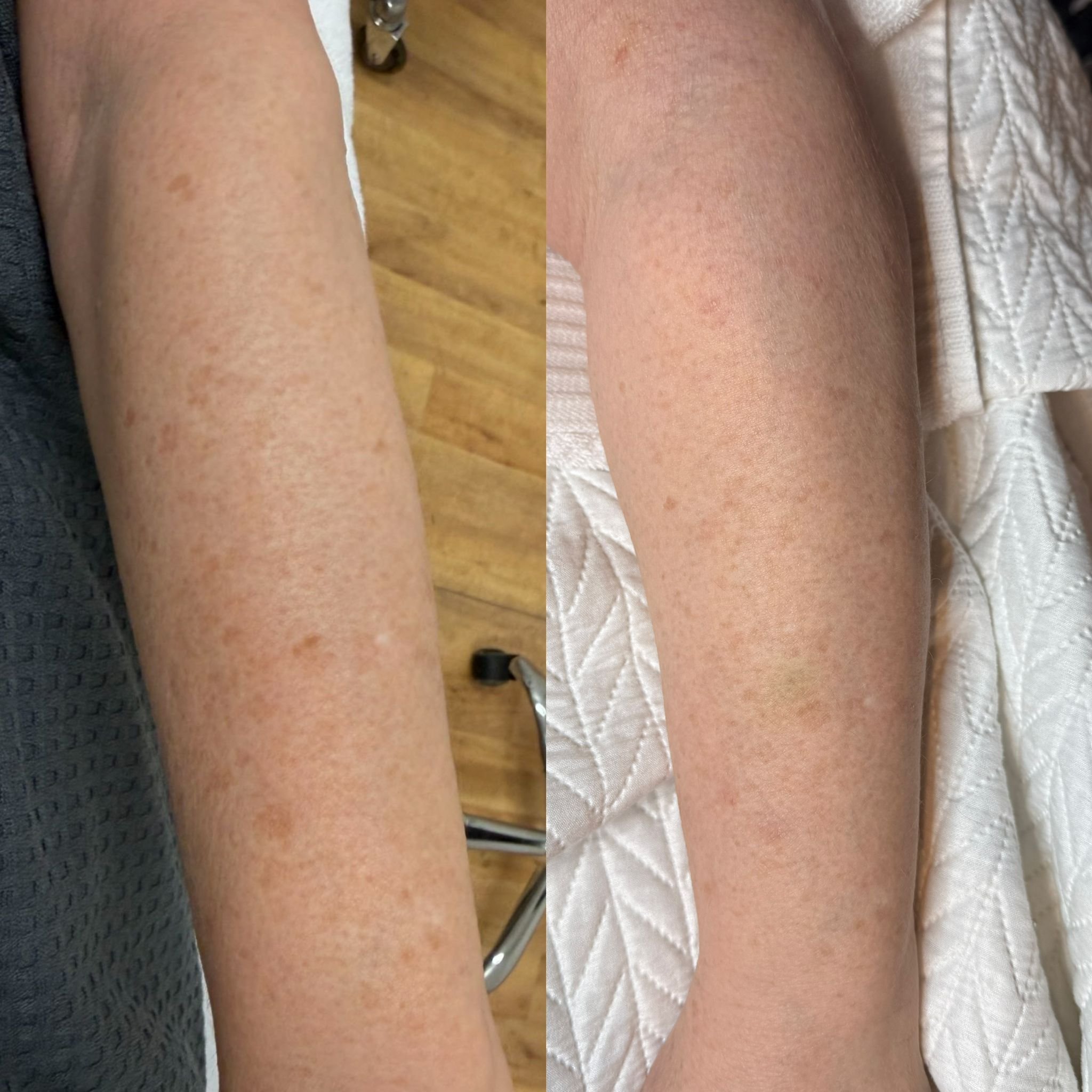 PICO Spot Treatment - 1 session - 532nm.jpeg