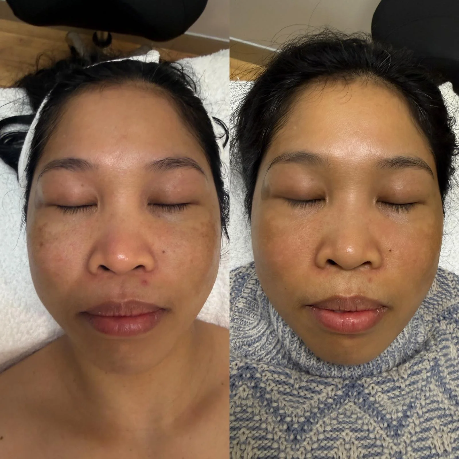 Pico Toning 1 - Chloe Regan Cosmetic Clinic.jpeg