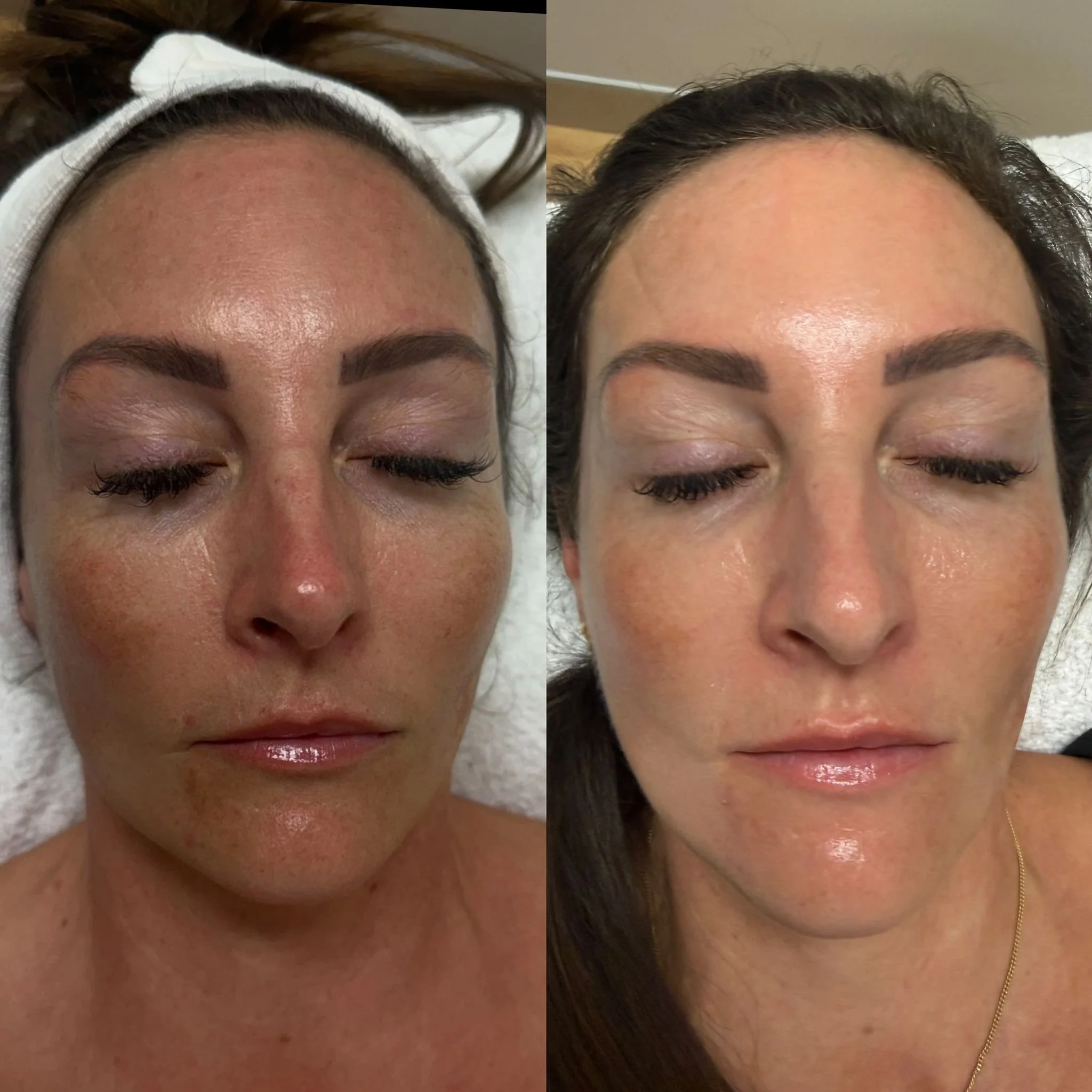 Pico Resurfacing 3 - Chloe Regan Cosmetic Clinic.jpeg